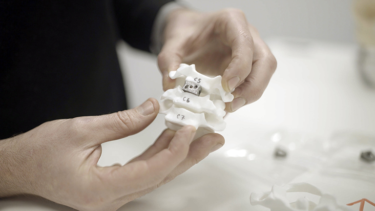 Precision Redefined: The Impact of 3D Printing on Spine Implants